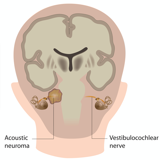 Acoustic Neuroma Explained box Michigan Ear Institute Acoustic